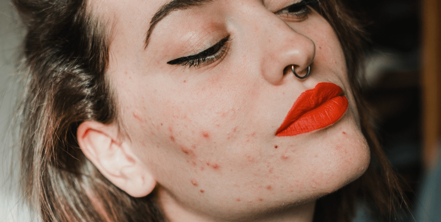 What are the real causes of sudden acne breakouts?
