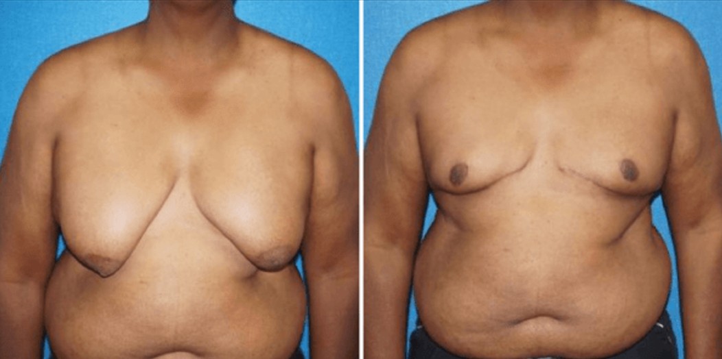 What to Do If You Have Large Male Breasts and You Want To Undergo Reduction Surgery