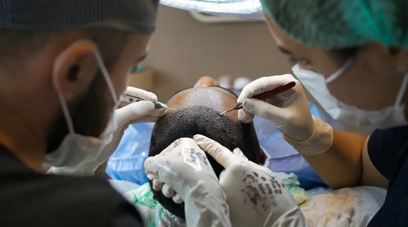 Where Do Hair Transplants Come From?