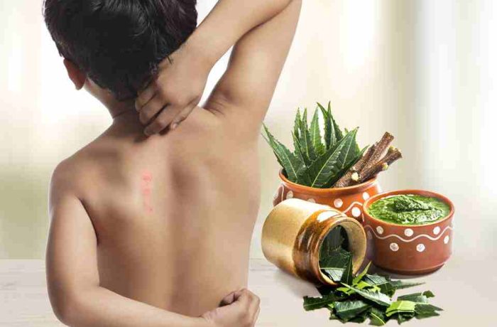 Understanding Heat Rash: Ayurvedic Insights and Remedies for Relief