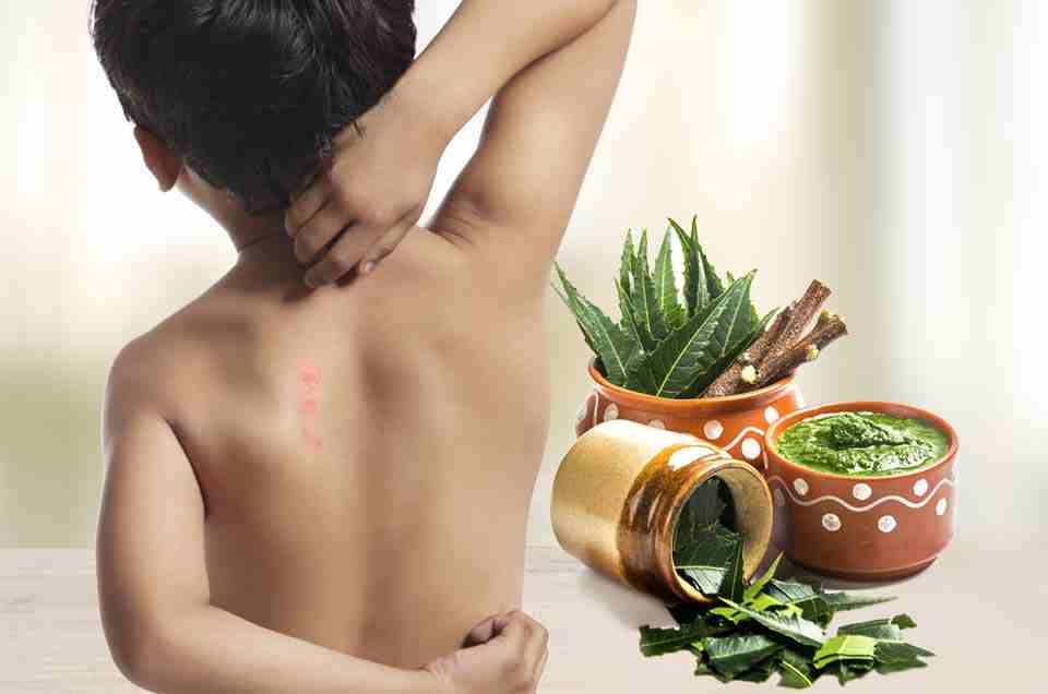 Understanding Heat Rash: Ayurvedic Insights and Remedies for Relief